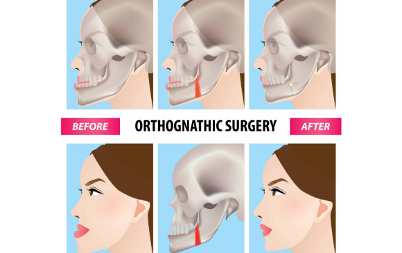 Orthognathic Surgery / Jaw Surgery - Atria-City Dental Group