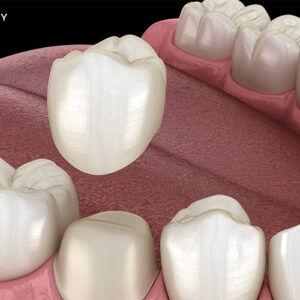 How dental crowns save severely damaged teeth