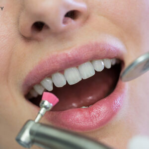 How scale and polish can help maintain oral hygiene