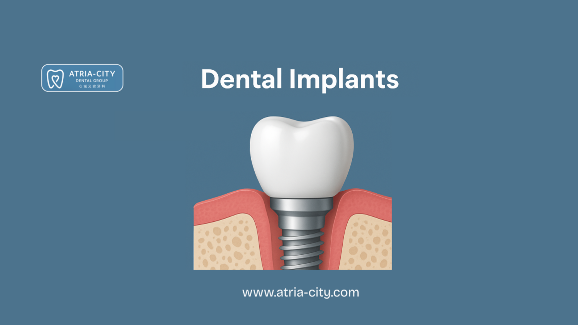 Dental Implants Cost in Singapore