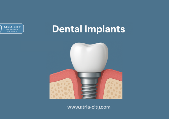 Dental Implants Cost in Singapore