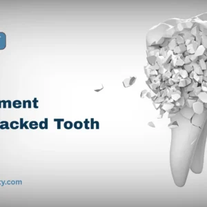 Treatment for Cracked Tooth in Singapore Atria-City