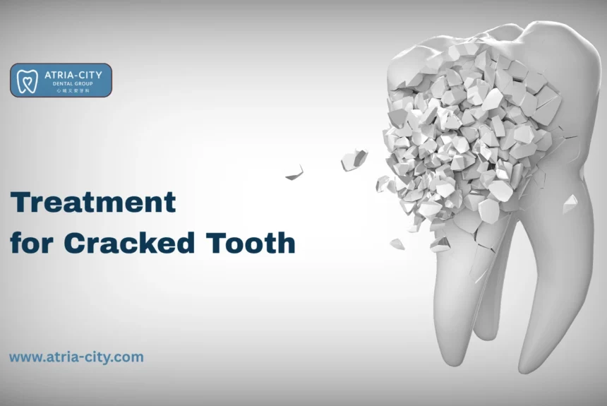 Treatment for Cracked Tooth in Singapore Atria-City