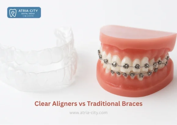 Clear Aligners vs Traditional Braces