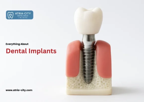 everything about dental implants