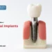 everything about dental implants