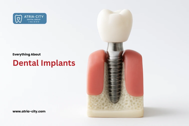 everything about dental implants everything about dental implants